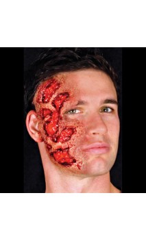 Blessure Brulé a vif